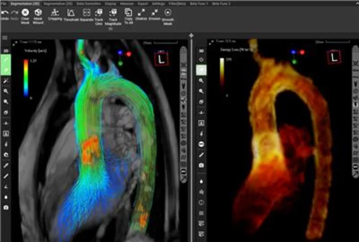 FDA Approves Innovative 4D Flow MRI Blood Flow Analysis Software from Cardio Flow Design Inc. (Japan) - Enhance Cardiovascular Diagnostic Accuracy