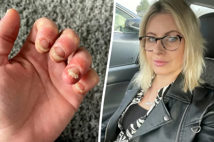Woman can barely move her hands after developing ‘allergy’ to gel nails