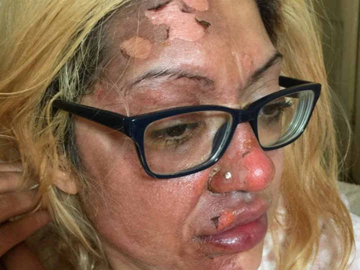 Mother’s warning after viral TikTok hack left skin peeling from her face