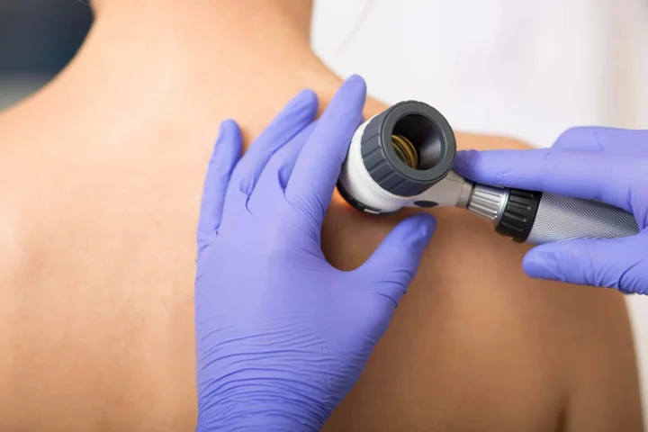 Skin cancer cases reach record high – how to spot the signs