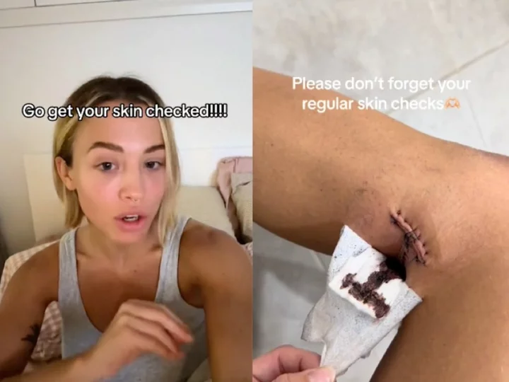 Influencer Tammy Hembrow angers fans by tanning in bikini weeks after having skin cancer removed