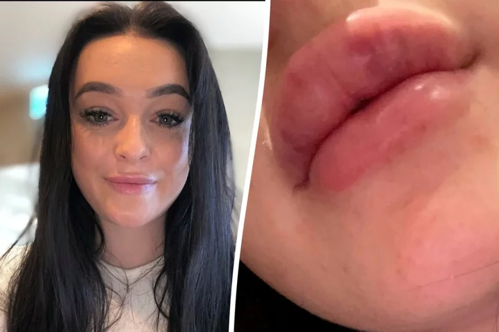 Woman’s warning after lip filler left her unable to close mouth