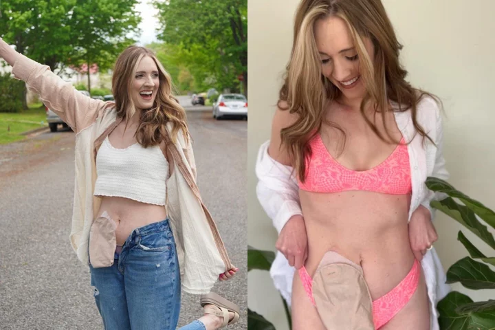 Mum with stoma bag shares bikini pictures to celebrate ‘second chance at life’ after cancer scare