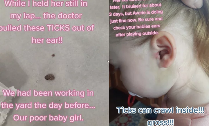 Mother shares horrifying moment she found ticks living in her daughter’s ear