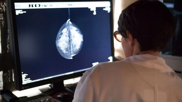 AI could be used to assess breast cancer scans
