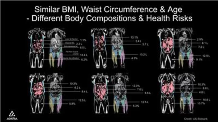 AMRA Medical´s Latest Research Finds a Strong Association Between Personalized Body Fat Z-Scores Describing Skewed Fat Distribution and Specific Cardiometabolic Risk Profiles