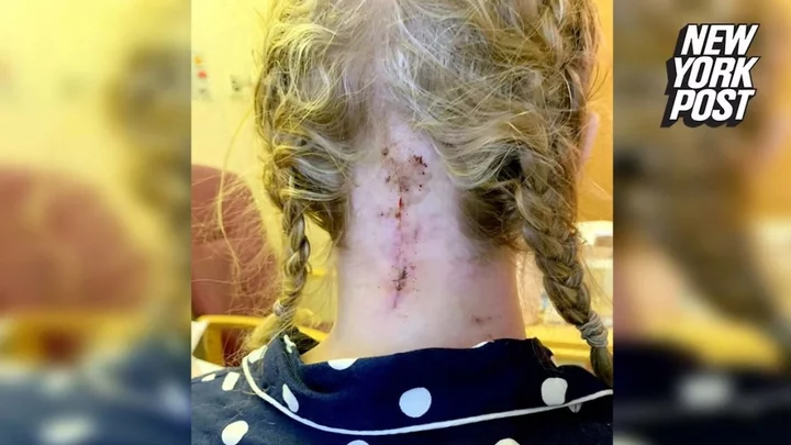Doctors reattach boy's head after suffering 'internal decapitation'